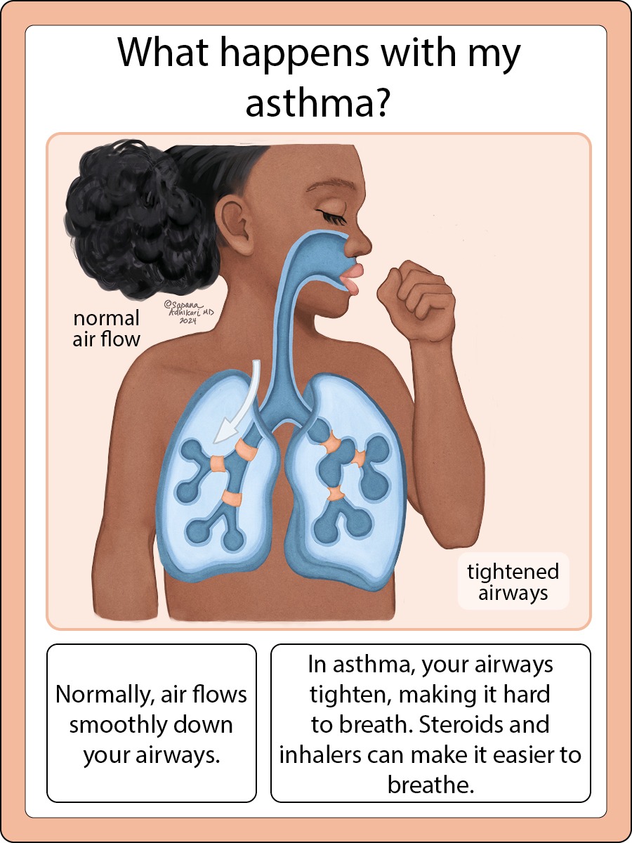 Simplified medical illustration of asthma, created by Sapana Adhikari, MD