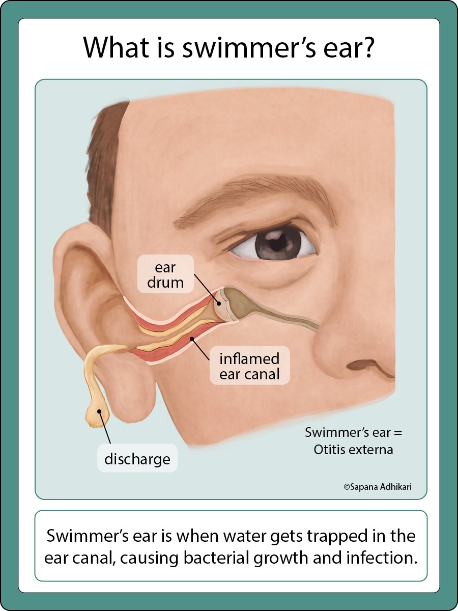 Simplified illustration of Swimmer's Ear by Sapana Adhikari, MD
