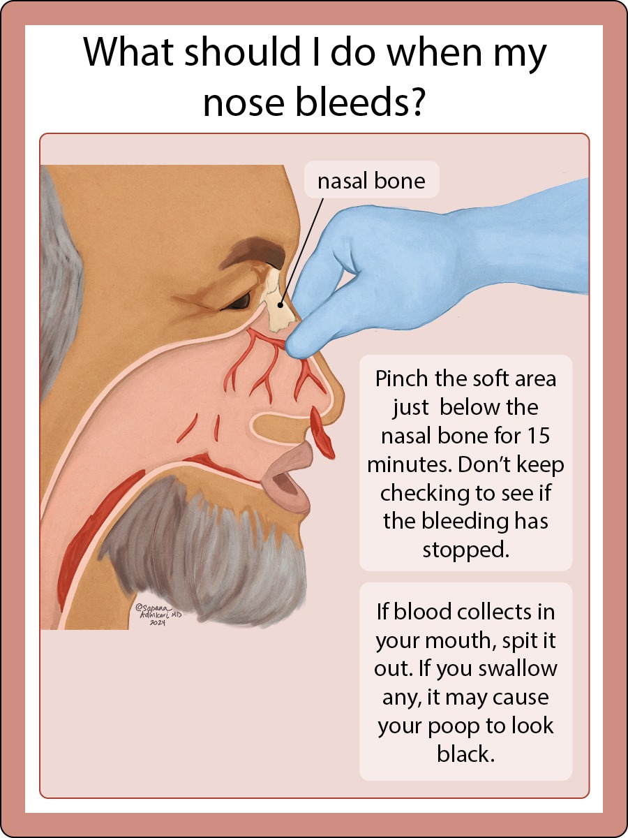 Simplified illustration to show what to do when you have a nose bleed by Sapana Adhikari, MD